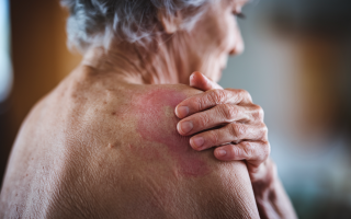 personne-agee-main-epaule-rougeur