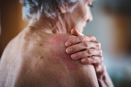 personne-agee-main-epaule-rougeur